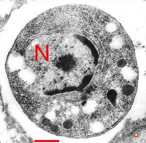 F,69y. | Toxoplasma gondii … brain … (radiation and chemotherapy)